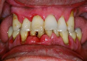 El Estrés y la evolución de la Enfermedad Periodontal. Factores de riesgo 8 Estrés y la evolución de la Enfermedad Periodontal