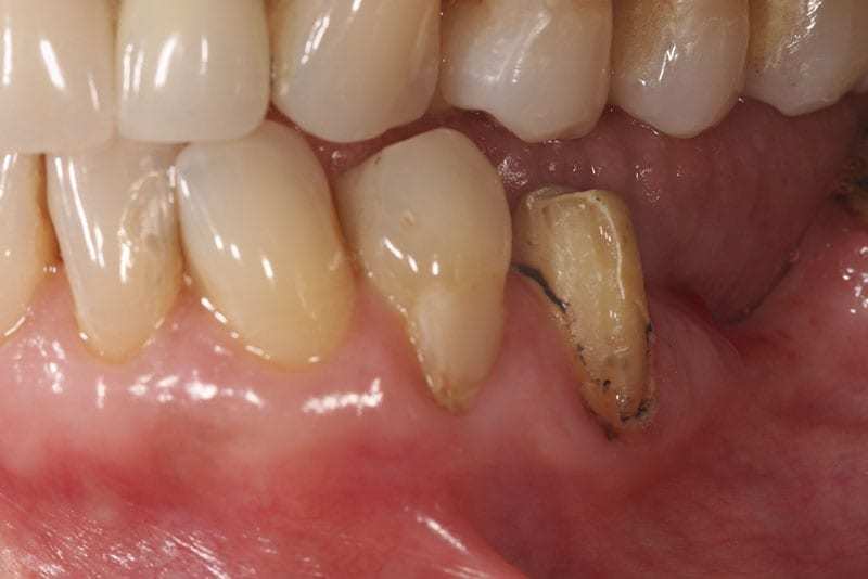 BOPT: Técnica de preparación Biológicamente orientada. Reporte de un caso 10 002.1 caso clinico tecnica biologicamente orientada