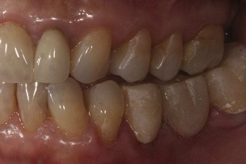 BOPT: Técnica de preparación Biológicamente orientada. Reporte de un caso 14 004 caso clinico tecnica biologicamente orientada