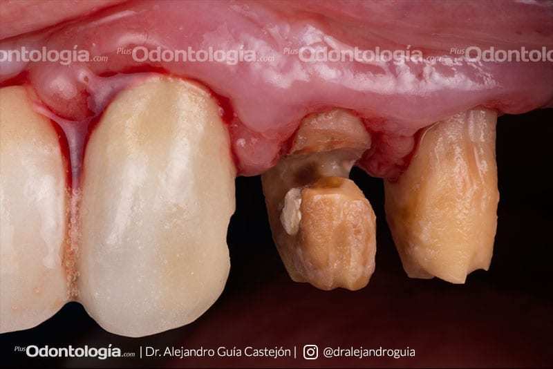 001 caso clinico implantes inmediatos
