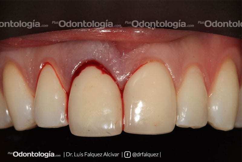 Colocación de implantes