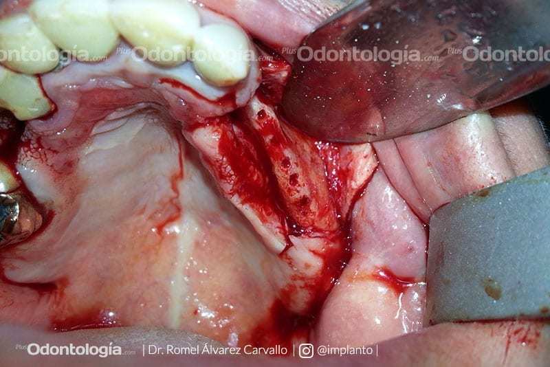 Flexicorticotomía alveolar en el tratamiento de implantes dentales 10 Flexicorticotomía alveolar en el tratamiento de implantes dentales