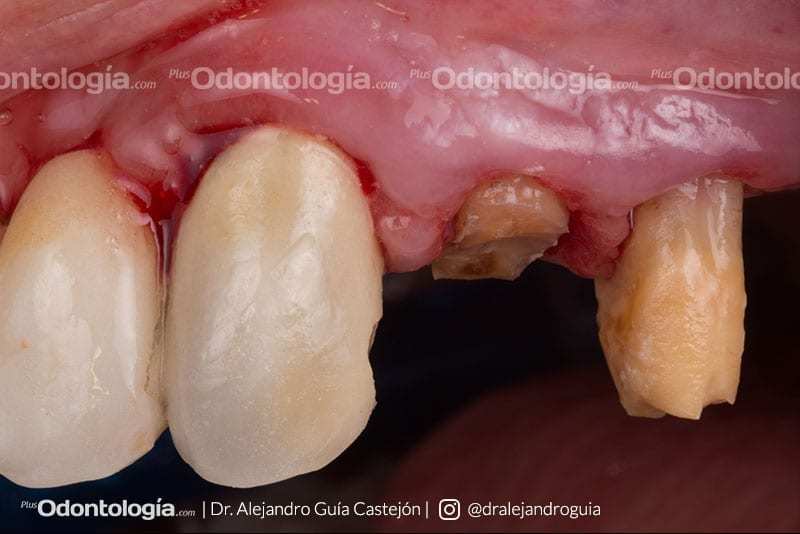 002 caso clinico implantes inmediatos
