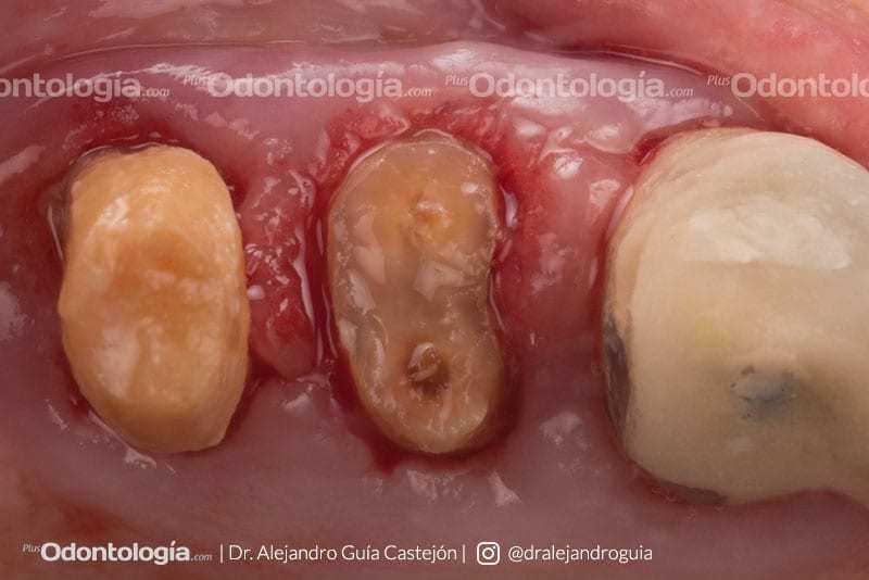 003 caso clinico implantes inmediatos