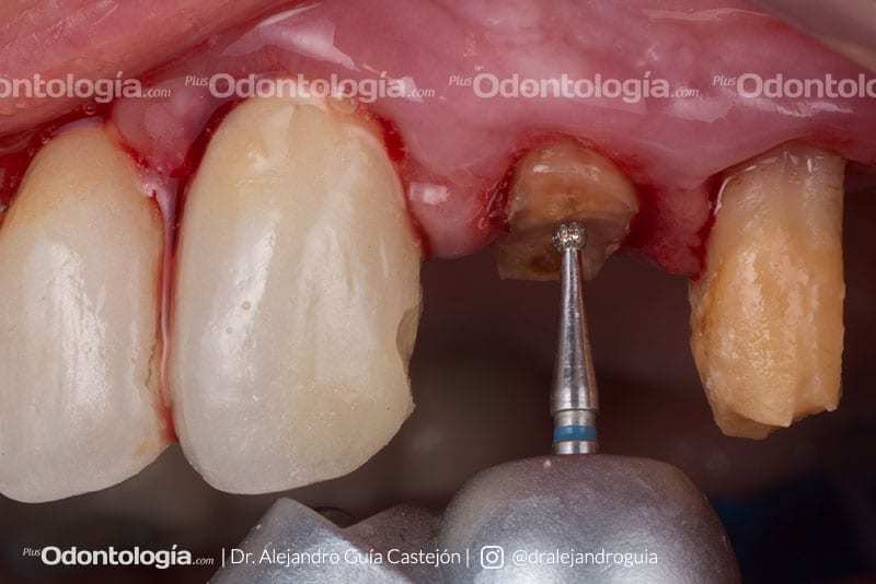 004 caso clinico implantes inmediatos