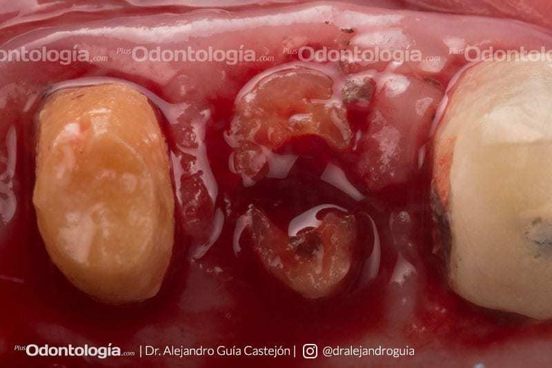 005 caso clinico implantes inmediatos