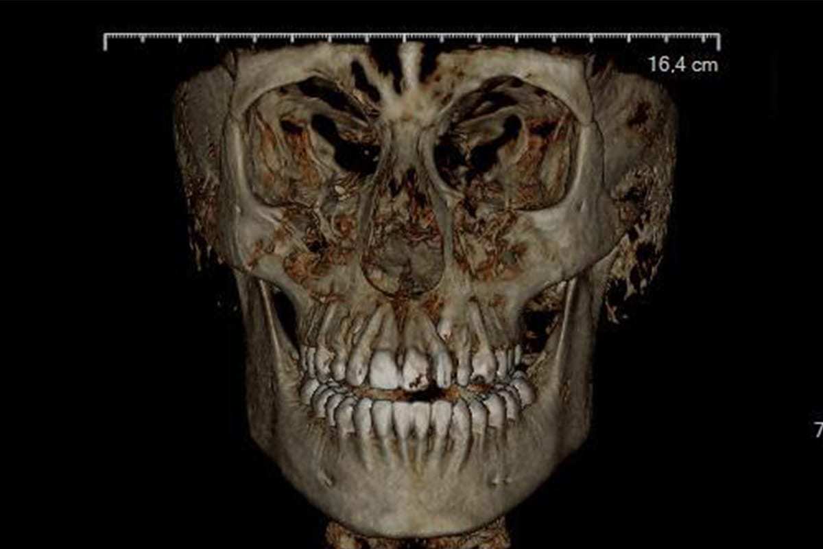 tomografia volumetrica en odontologia