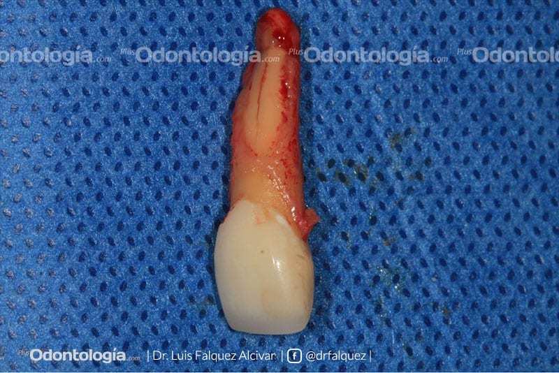 Colocación Palatina de Implantes