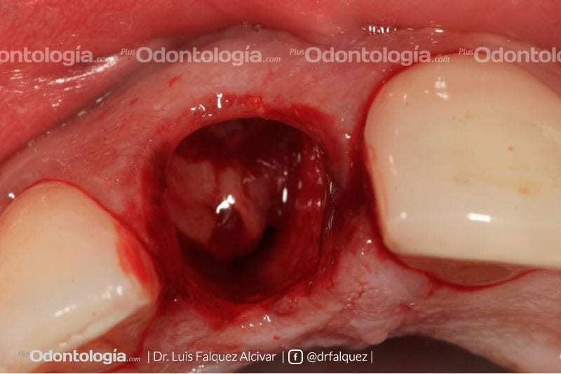 Colocación Palatina de Implantes