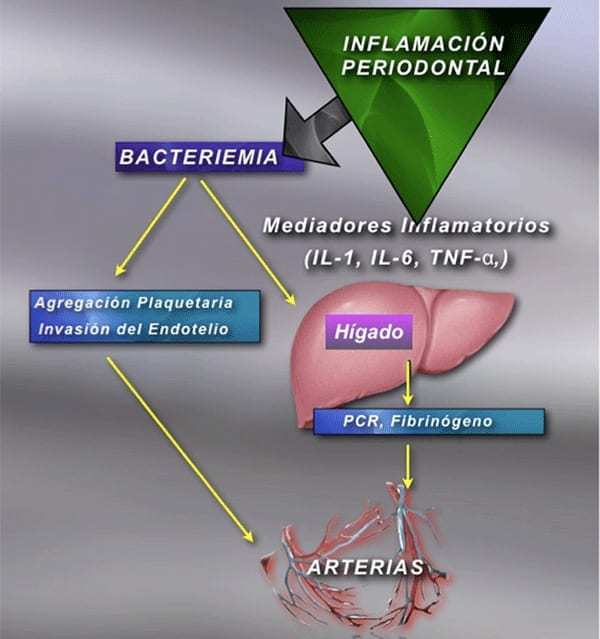 Relación entre la Periodontitis Crónica y la Aterosclerosis 8 Imagen 2