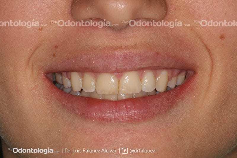 Carillas de Porcelana con Técnica modificada de Alargamiento Coronario 10 001 2 posicion sonrisa no forzada