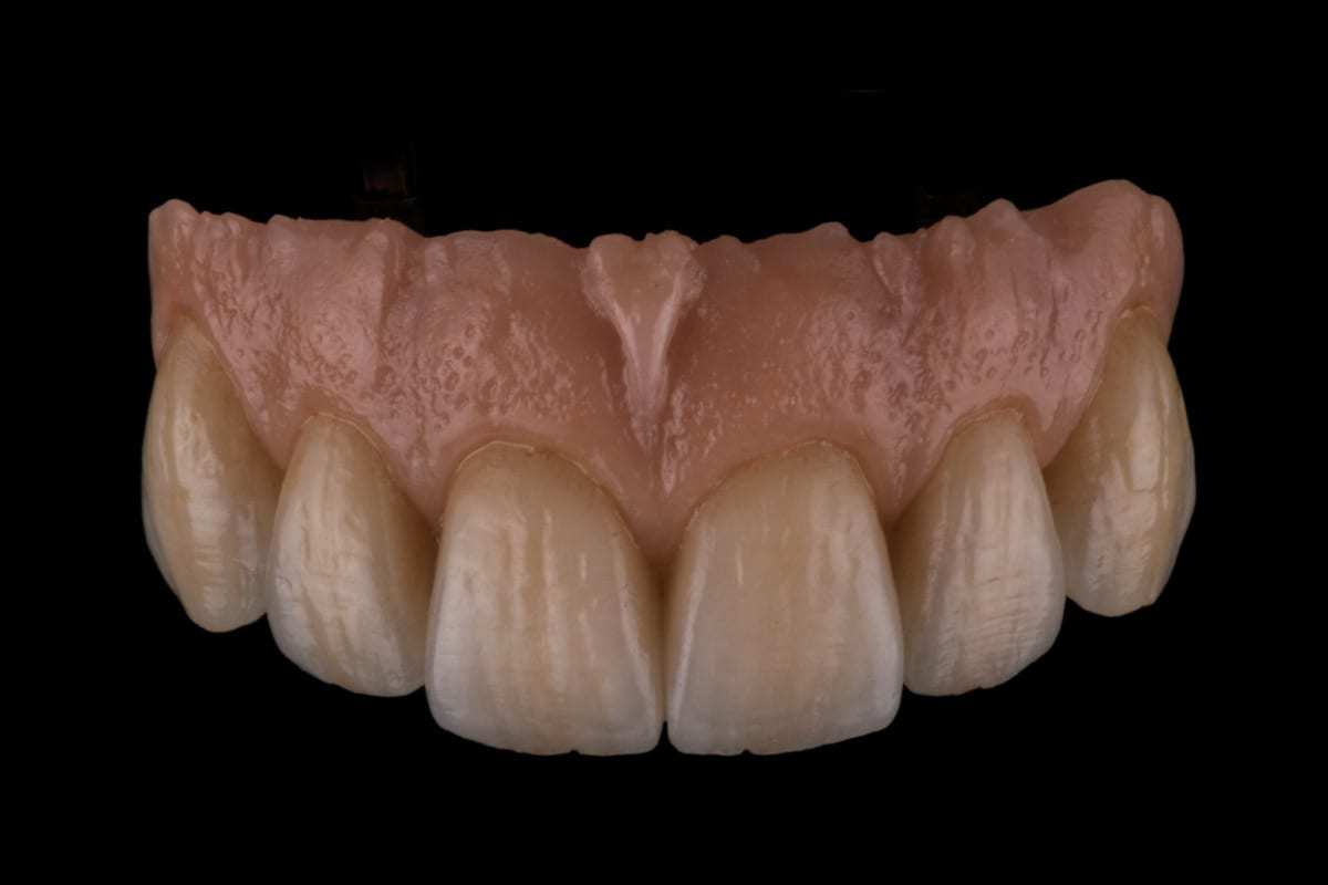 Planificación de prótesis fija Dentogingival para el sector anterior 16
