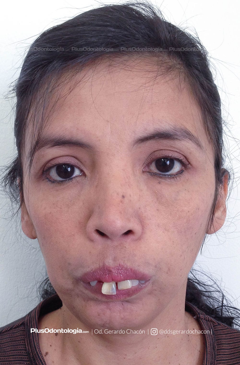 gerardo chacon implantes dentales 1