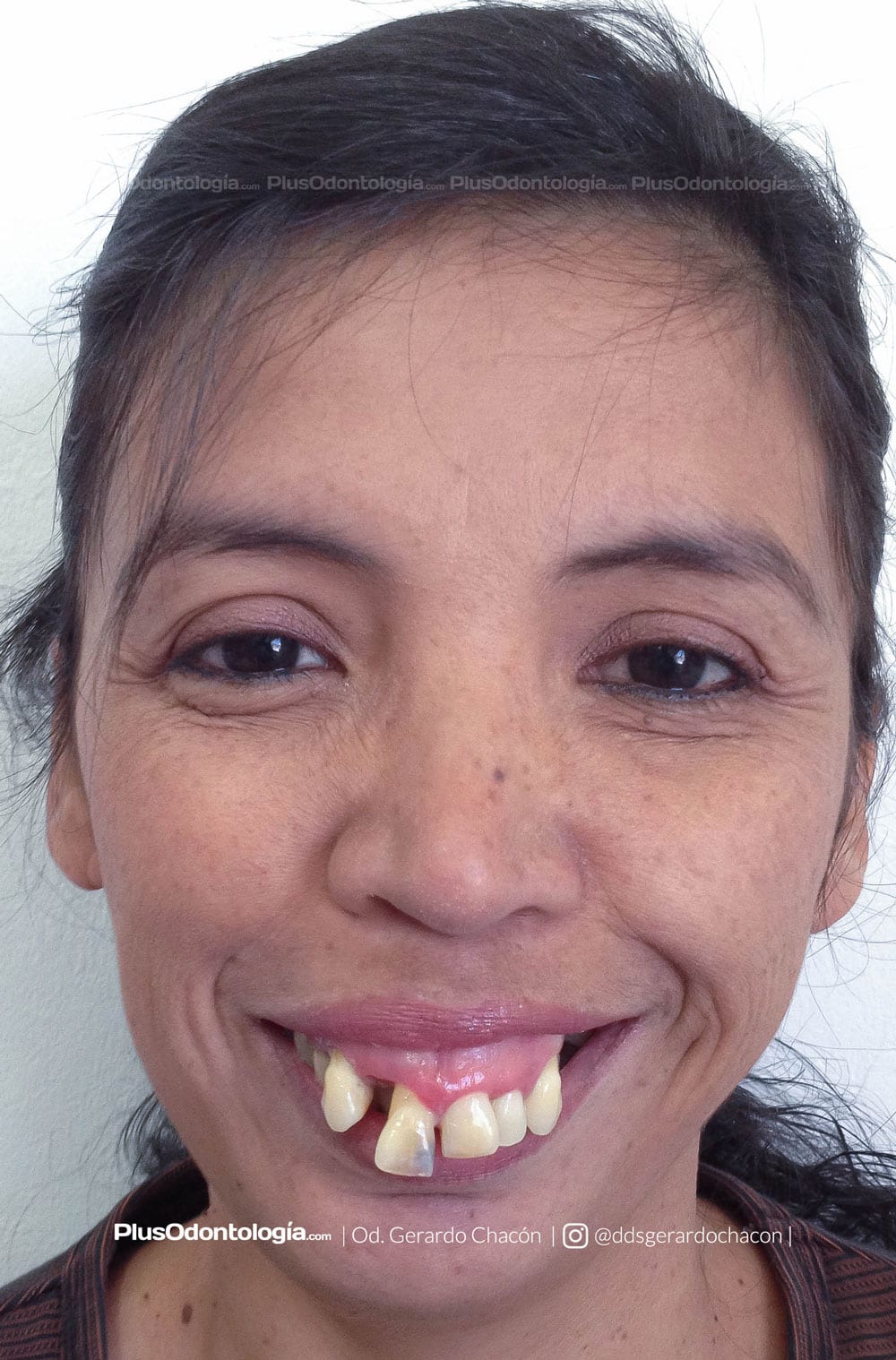 gerardo chacon implantes dentales 3