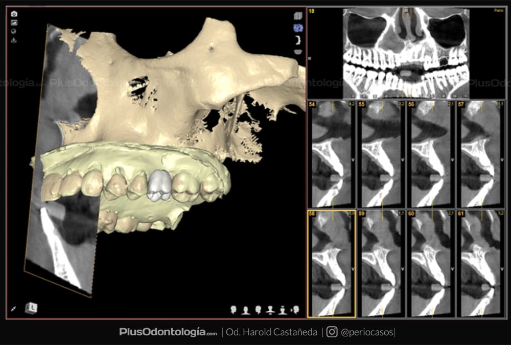 001 harold castañeda implantes dentales planificacion virtual