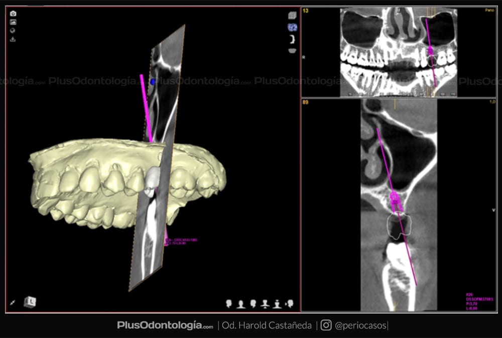 002 harold castañeda implantes dentales planificacion virtual