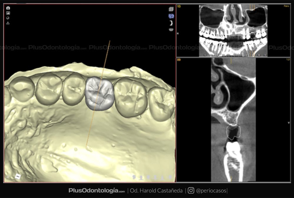 004 harold castañeda implantes dentales planificacion virtual