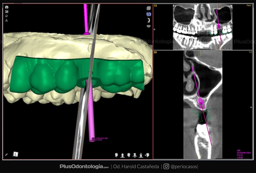 006 harold castañeda implantes dentales planificacion virtual