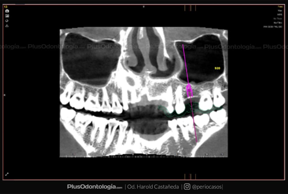 007 harold castañeda implantes dentales planificacion virtual