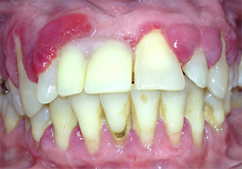 Mecanismos de vinculación entre la Periodontitis y el Alzheimer 11 alzheimer y periodontitis