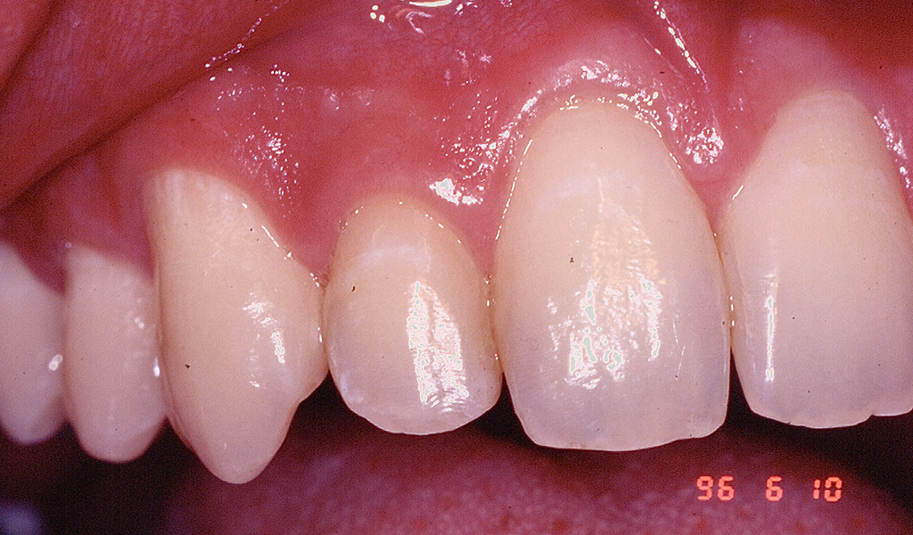 Regeneración periodontal de defecto óseo con injerto aloplástico 8 regeneracion periodontal injerto aloplastico 1