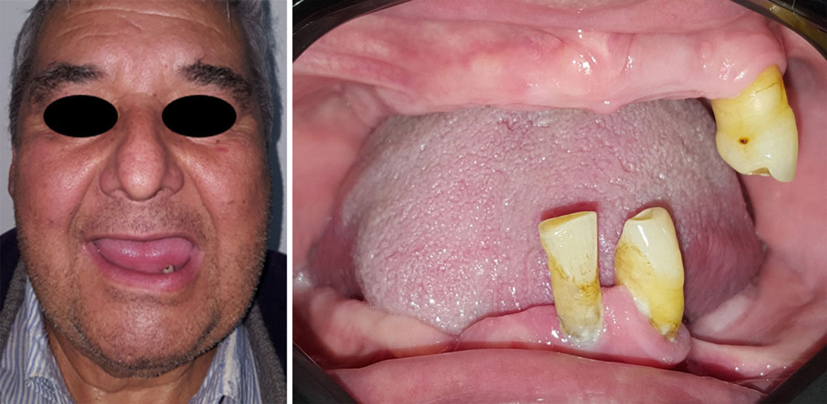 Técnica All-on-Four con implantes inclinados en maxilares atróficos 8 All on four plus odontologia miguel jaimes 1