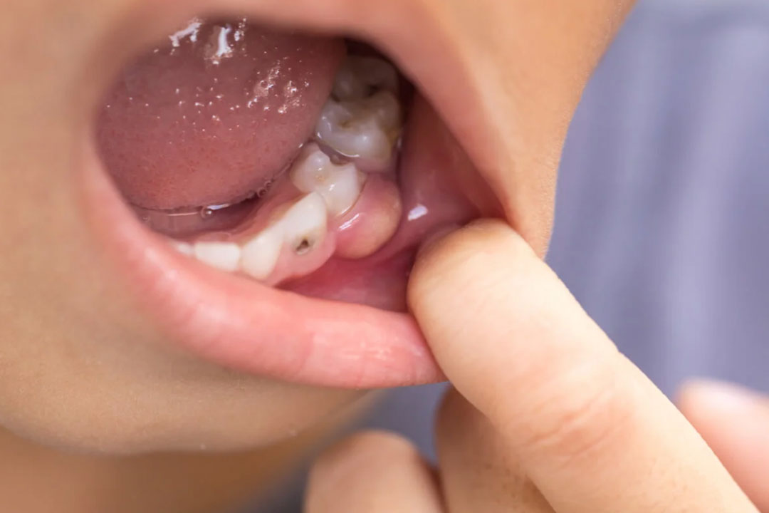 infecciones-odontogenicas infecciones odontogenicas