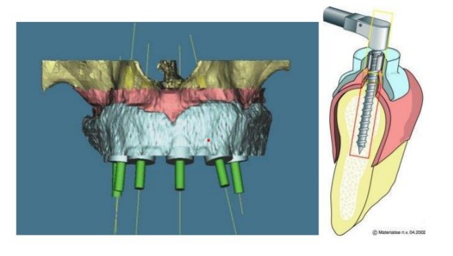 guia quirúrgica 3D de apoyo mucoso Guía quirúrgica 3D de apoyo mucoso