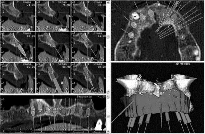 planificacion quirurgica con software e imagen CBCT planificacion quirurgica con software e imagen CBCT