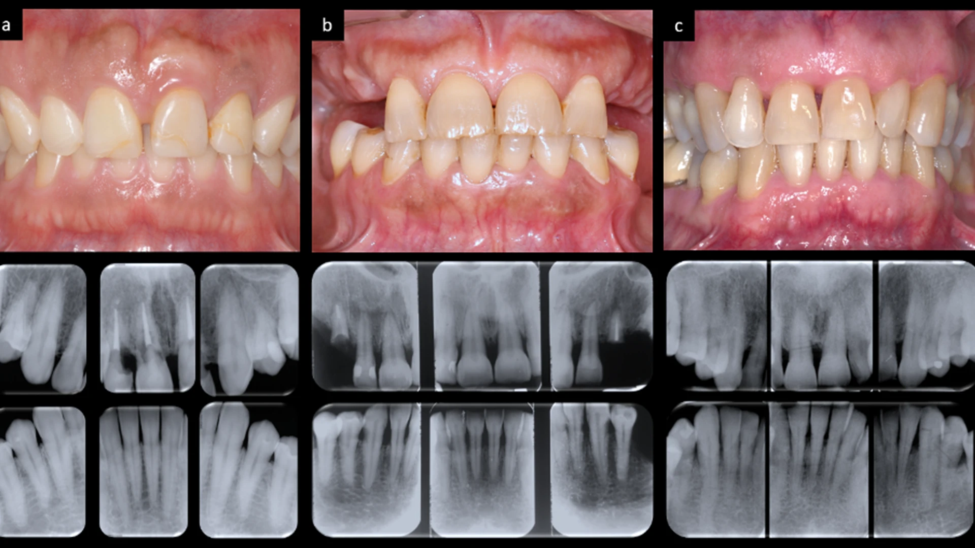 caracterizacion clinica de enfermedades periodontales revista plusodontologia gredy lugo
