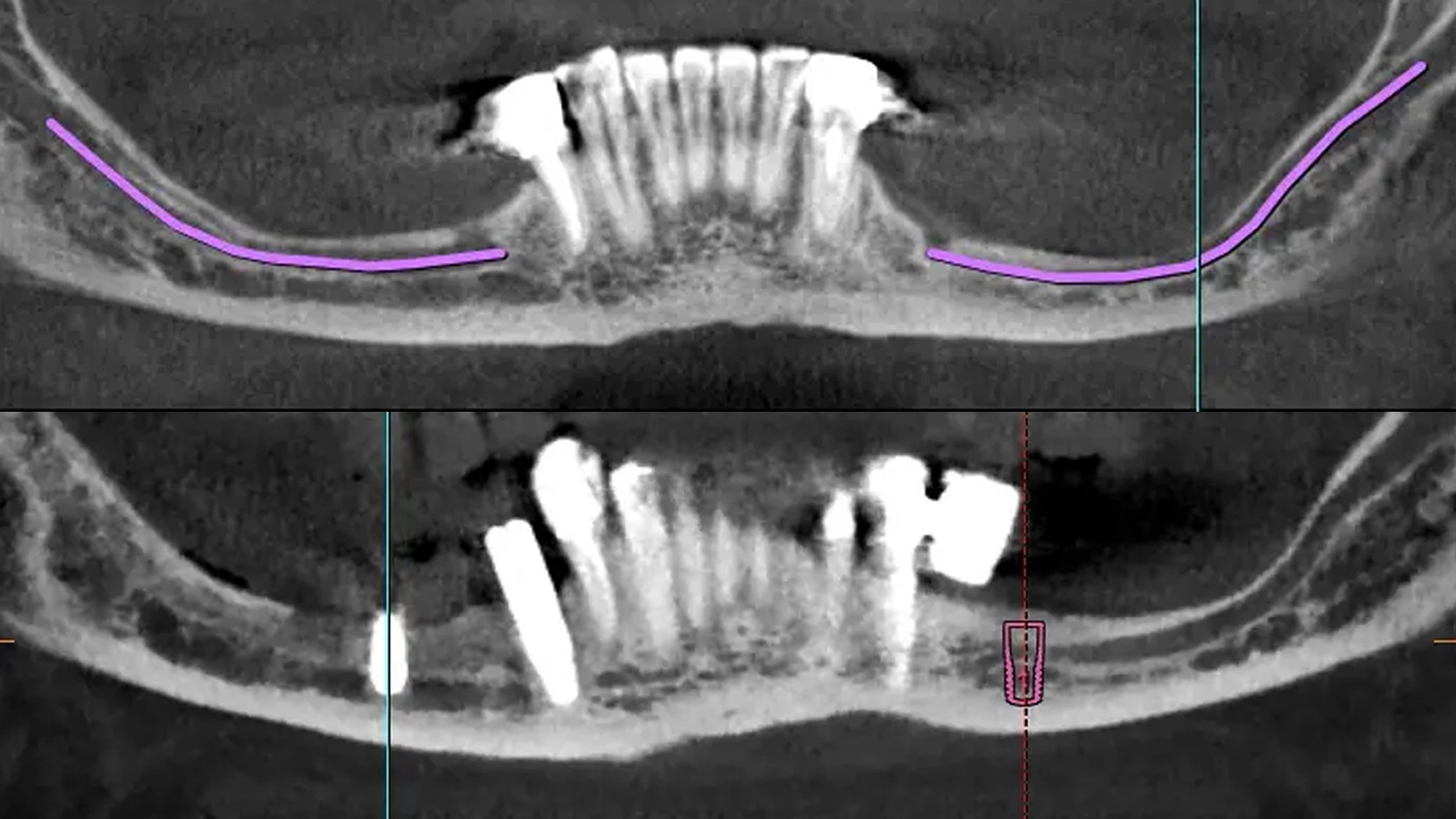 Lateralizacion del nervio alveolar inferior en el tratamiento de atrofia vertical