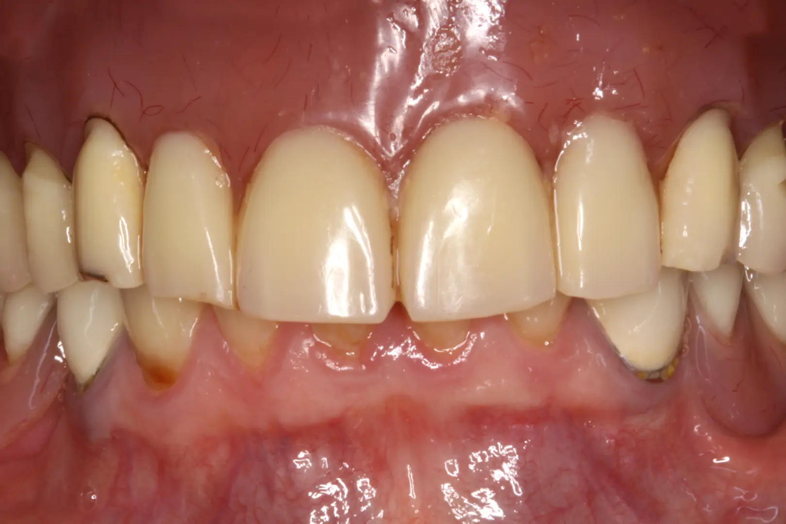 Lateralización del nervio alveolar inferior en el tratamiento de atrofia vertical severa del sector posterior mandibular 8 figura 1