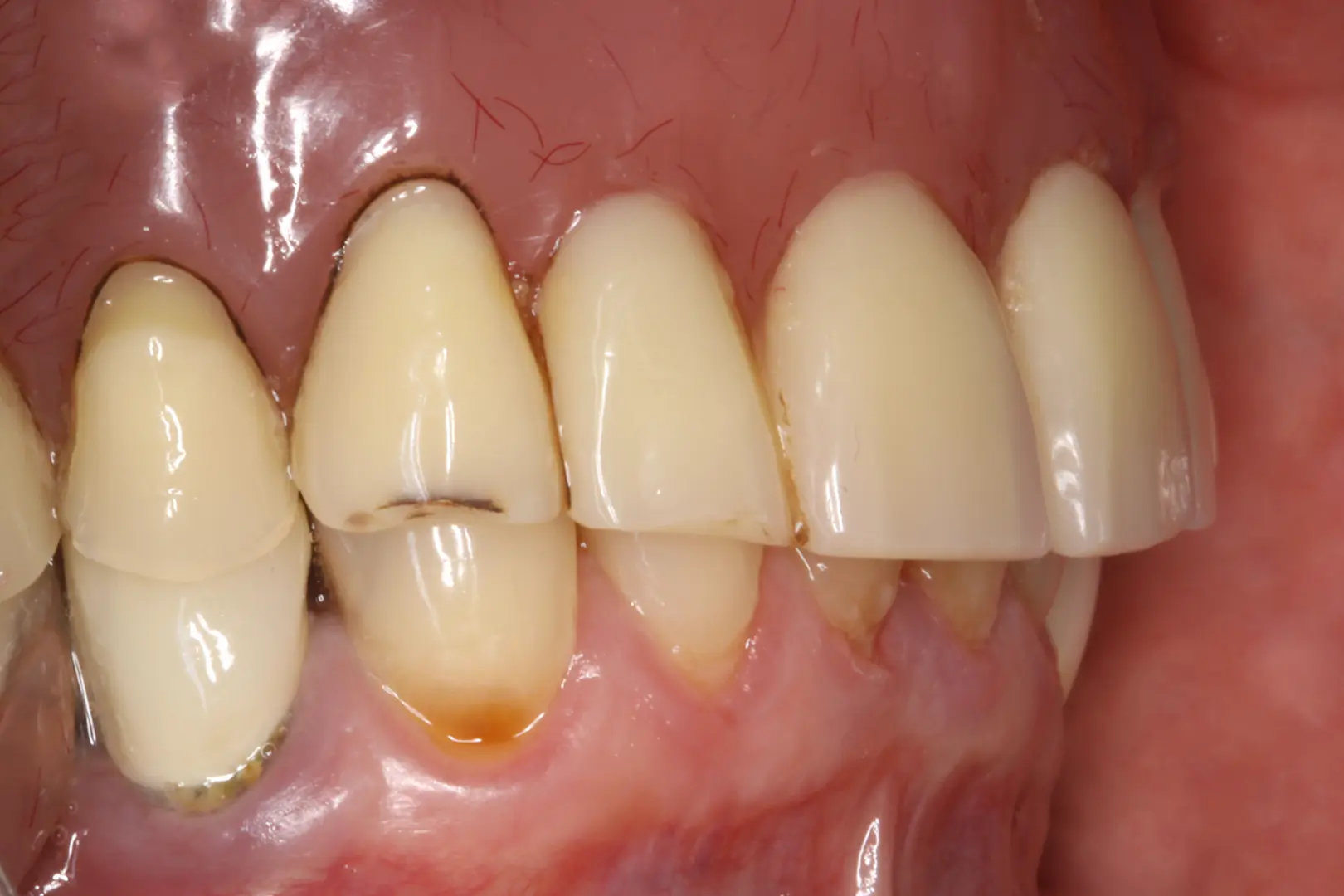 Lateralización del nervio alveolar inferior en el tratamiento de atrofia vertical severa del sector posterior mandibular 9 figura 2